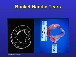 Bucket Handle Tears Courtesy of John Crues, MD 