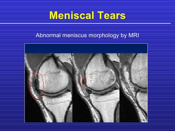 Meniscus repair