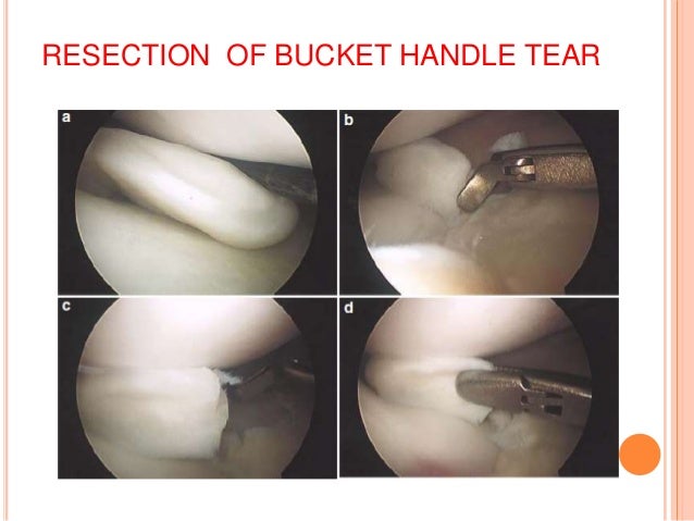 Arthroscopic Meniscus Surgery: Resect or Repair 2014