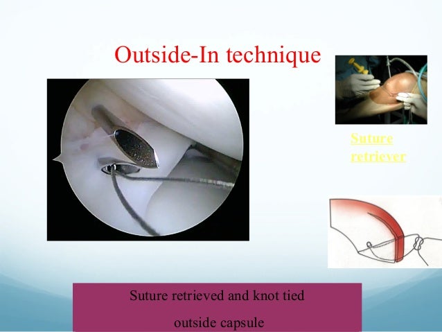 meniscus repair conmed linvatec