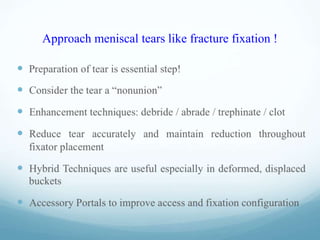 Approach meniscal tears like fracture fixation !
 
