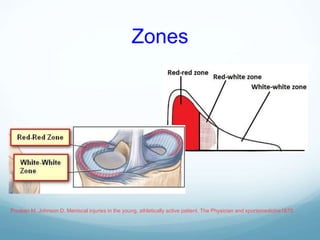Zones
Poulsen M, Johnson D. Meniscal injuries in the young, athletically active patient. The Physician and sportsmedicine1870.
 