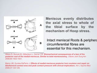 Meniscus evenly distributes
the axial stress to whole of
the tibial surface by the
mechanism of Hoop stress.
Intact meniscal Roots & periphera
circumferential fibres are
essential for this mechanism.
Allaire R, Muriuki M, Gilbertson L, Harner CD. Biomechanical consequences of a tear of the
posterior root of the medial meniscus. Similar to total meniscectomy. J Bone Joint Surg Am
2008;90:1922-1931.
Marzo JM, Gurske-DePerio J. Effects of medial meniscus posterior horn avulsion and repair on
tibiofemoral contact area and peak contact pressure with clinical implications. Am J Sports Med
2009;37:124-129.
 