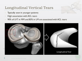 • Typically seen in younger patients
• High association with ACL tears
• 90% of LVT in MM and 83% in LM are associated withACL tears
Longitudinal Vertical Tears
 