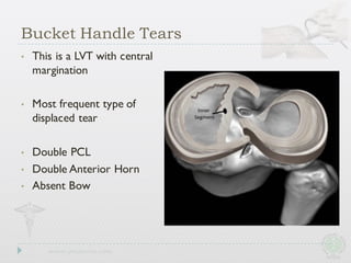 • This is a LVT with central
margination
• Most frequent type of
displaced tear
• Double PCL
• Double Anterior Horn
• Absent Bow
Bucket Handle Tears
 
