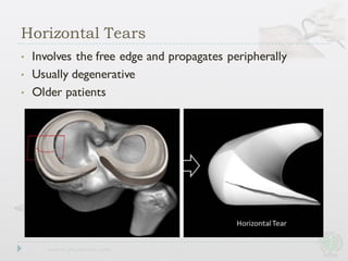 • Involves the free edge and propagates peripherally
• Usually degenerative
• Older patients
Horizontal Tears
 