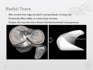 • Also involve free edge,but path is perpendicular to long axis
• Drastically affect ability to resist hoop stresses
• Deeper the tear,the more drastic the biomechanical consequences
Radial Tears
 