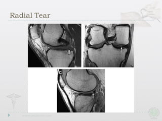 Radial Tear
 