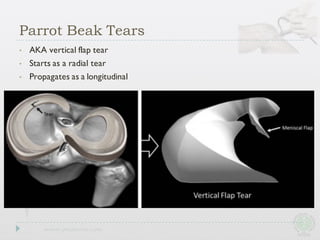 • AKA vertical flap tear
• Starts as a radial tear
• Propagates as a longitudinal
Parrot Beak Tears
 