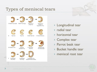 Types of meniscal tears
} Longitudinal tear
} radial tear
} horizontal tear
} Complex tear
} Parrot beak tear
} Bucket handle tear
} meniscal root tear
 