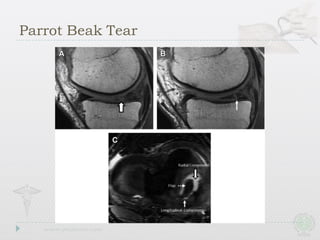 Parrot Beak Tear
 