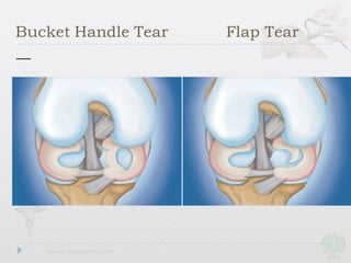 Bucket Handle Tear Flap Tear
 