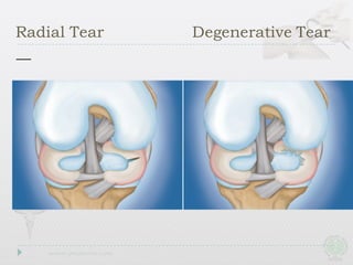 Radial Tear Degenerative Tear
 