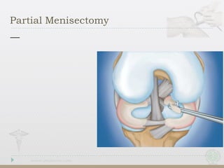 Partial Menisectomy
 