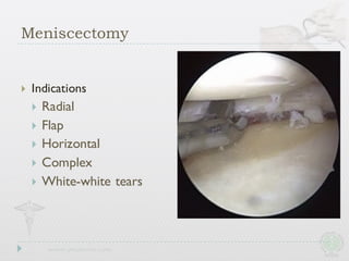 } Indications
} Radial
} Flap
} Horizontal
} Complex
} White-white tears
Meniscectomy
 