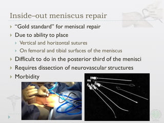 Inside–out meniscus repair
} “Gold standard” for meniscal repair
} Due to ability to place
} Vertical and horizontal sutures
} On femoral and tibial surfaces of the meniscus
} Difficult to do in the posterior third of the menisci
} Requires dissection of neurovascular structures
} Morbidity
 