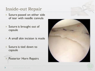 Inside-out Repair
} Suture passed on either side
of tear with needle cannula
} Suture is brought out of
capsule
} A small skin incision is made
} Suture is tied down to
capsule
} Posterior Horn Repairs
 