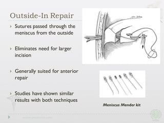 } Sutures passed through the
meniscus from the outside
} Eliminates need for larger
incision
} Generally suited for anterior
repair
} Studies have shown similar
results with both techniques
Outside-In Repair
Meniscus Mender kit
 