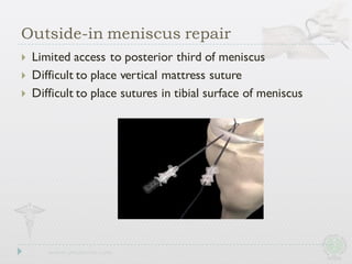 Outside-in meniscus repair
} Limited access to posterior third of meniscus
} Difficult to place vertical mattress suture
} Difficult to place sutures in tibial surface of meniscus
 
