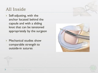 } Self-adjusting, with the
anchor located behind the
capsule and with a sliding
knot that can be tensioned
appropriately by the surgeon
} Mechanical studies show
comparable strength to
outside-in sutures
All Inside
 
