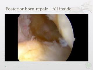 Posterior horn repair – All inside
 