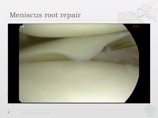 Meniscus root repair
 