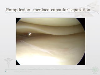 Ramp lesion- menisco-capsular separation
 