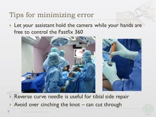 Tips for minimizing error
} Let your assistant hold the camera while your hands are
free to control the Fastfix 360
} Reverse curve needle is useful for tibial side repair
} Avoid over cinching the knot – can cut through
 
