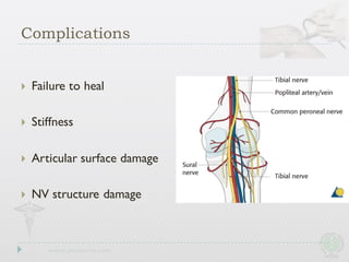 } Failure to heal
} Stiffness
} Articular surface damage
} NV structure damage
Complications
 