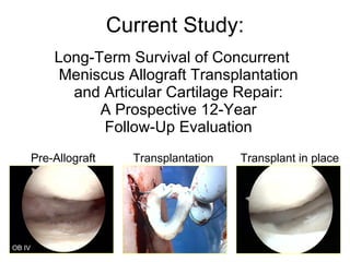 Current Study: Long-Term Survival of Concurrent  Meniscus Allograft Transplantation  and Articular Cartilage Repair:  A Prospective 12-Year  Follow-Up Evaluation  Pre-Allograft Transplant in place Transplantation OB IV 