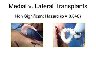 Medial v. Lateral Transplants Non Significant Hazard (p = 0.848) Medial (N = 85) KM mean survival: 9.91 ± 0.46 years Lateral (N = 34) KM mean survival: 10.17 ± 0.78 years 