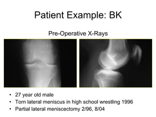 Patient Example: BK 27 year old male Torn lateral meniscus in high school wrestling 1996 Partial lateral meniscectomy 2/96, 8/04 Pre-Operative X-Rays 