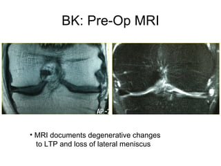 BK: Pre-Op MRI MRI documents degenerative changes   to LTP and loss of lateral meniscus 