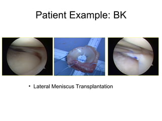 Patient Example: BK Lateral Meniscus Transplantation 