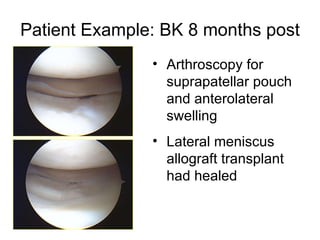 Patient Example: BK 8 months post  Arthroscopy for suprapatellar pouch and anterolateral swelling Lateral meniscus allograft transplant had healed 