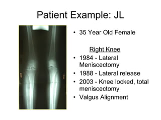 Patient Example: JL 35 Year Old Female Right Knee   1984 - Lateral Meniscectomy 1988 - Lateral release 2003 - Knee locked, total meniscectomy Valgus Alignment  