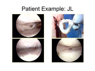 Patient Example: JL OB III/IV far-posterior aspect LFC, Microfracture LFC 