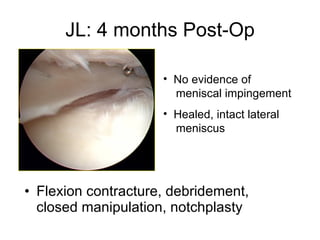 JL: 4 months Post-Op Flexion contracture, debridement, closed manipulation, notchplasty No evidence of   meniscal impingement Healed, intact lateral   meniscus 