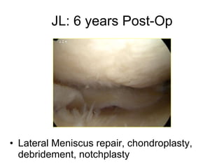JL: 6 years Post-Op Lateral Meniscus repair, chondroplasty, debridement, notchplasty 