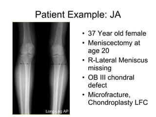 Patient Example: JA 37 Year old female Meniscectomy at age 20 R-Lateral Meniscus missing OB III chondral defect Microfracture, Chondroplasty LFC Long-Leg AP 