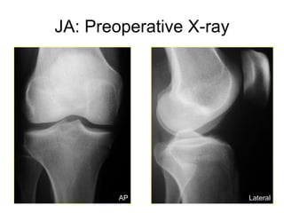 JA: Preoperative X-ray Lateral AP 