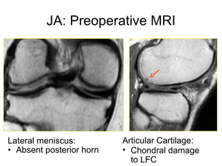 JA: Preoperative MRI Lateral meniscus: Absent posterior horn Articular Cartilage: Chondral damage to LFC 