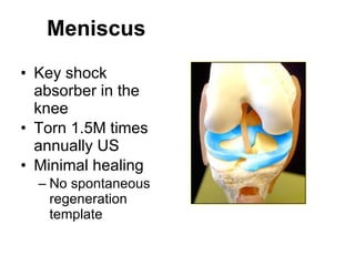 Meniscus   Key shock absorber in the knee Torn 1.5M times annually US Minimal healing No spontaneous regeneration template 