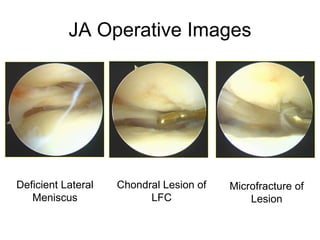 JA Operative Images A B C Deficient Lateral Meniscus Chondral Lesion of LFC Microfracture of Lesion 
