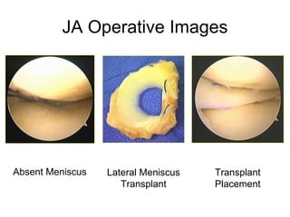 JA Operative Images A B C Absent Meniscus Lateral Meniscus Transplant Transplant Placement 