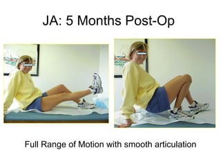 JA: 5 Months Post-Op  Full Range of Motion with smooth articulation 