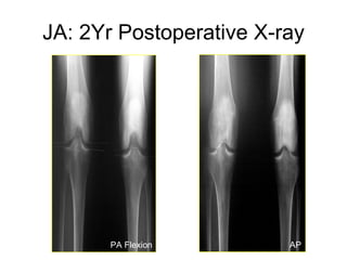JA: 2Yr Postoperative X-ray PA Flexion AP 