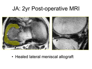 JA: 2yr Post-operative MRI Healed lateral meniscal allograft 