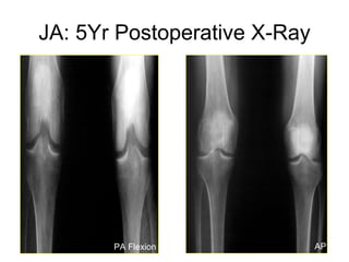 JA: 5Yr Postoperative X-Ray PA Flexion AP 