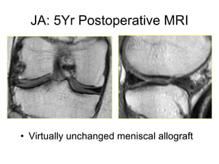 JA: 5Yr Postoperative MRI Virtually unchanged meniscal allograft 